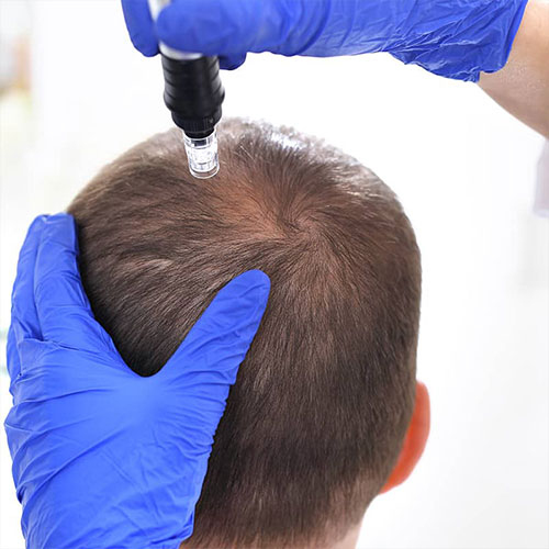 بهترین سن برای مزوتراپی مو، مدت اثرگذاری آن