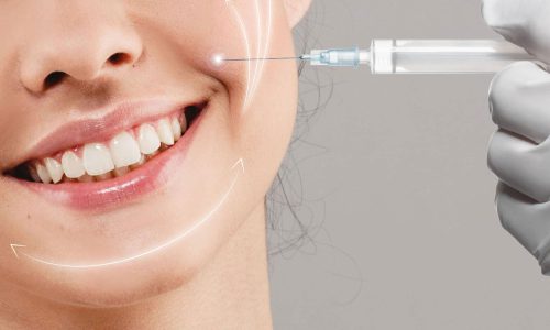 procedures-to-get-rid-of-smile-lines-to-get-scaled